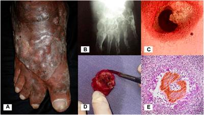 An update on the development of novel antifungal agents for eumycetoma